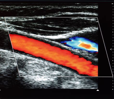 ultrasound measuring carotid intima-media thickness test|carotid intima media thickness guidelines.